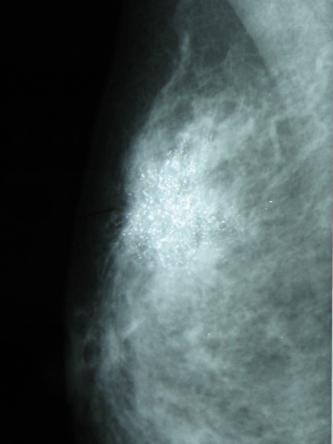 Meditrina Mammogram